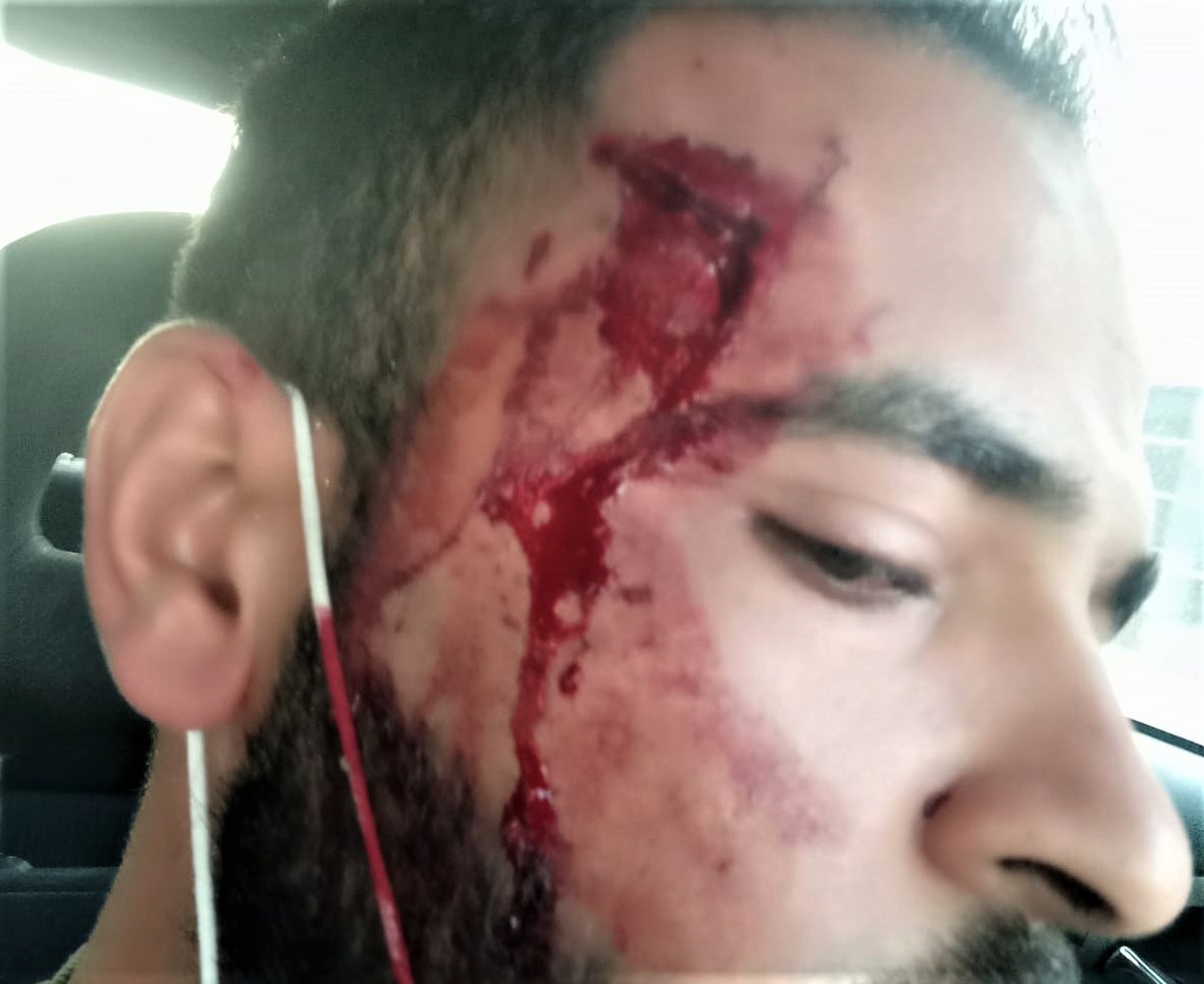 الجُرح في جبين صادق خطاطبة نتيجة حُطام زجاج السيّارة المتناثر جرّاء حجر رشقه مستوطن على السيّارة التي كان يستقلّها. شارع 60، 21.12.20. تصوير صادق خطاطبة.