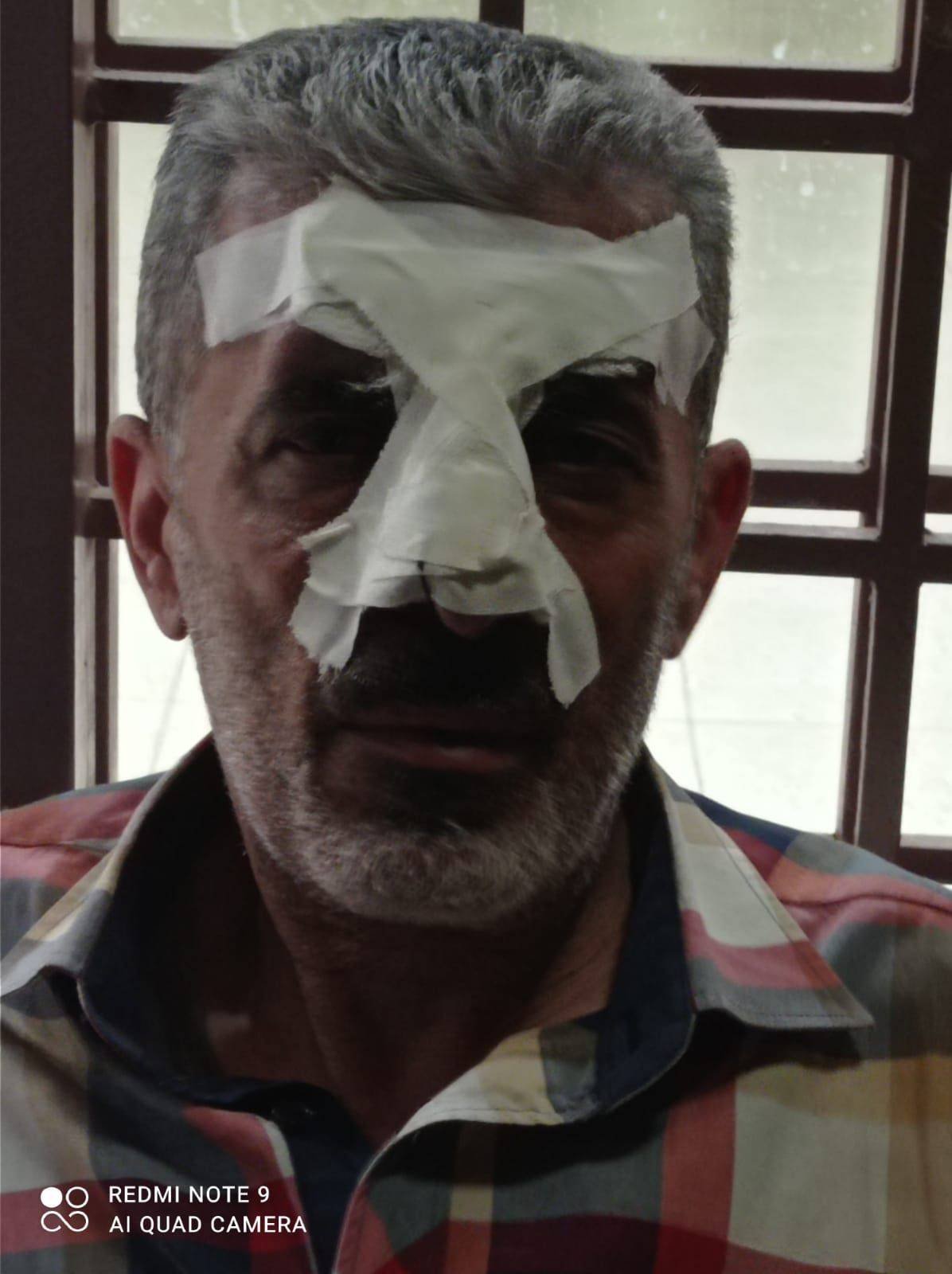 ‘Abd a-Nasser Dmeidi after his nose was bandaged. 