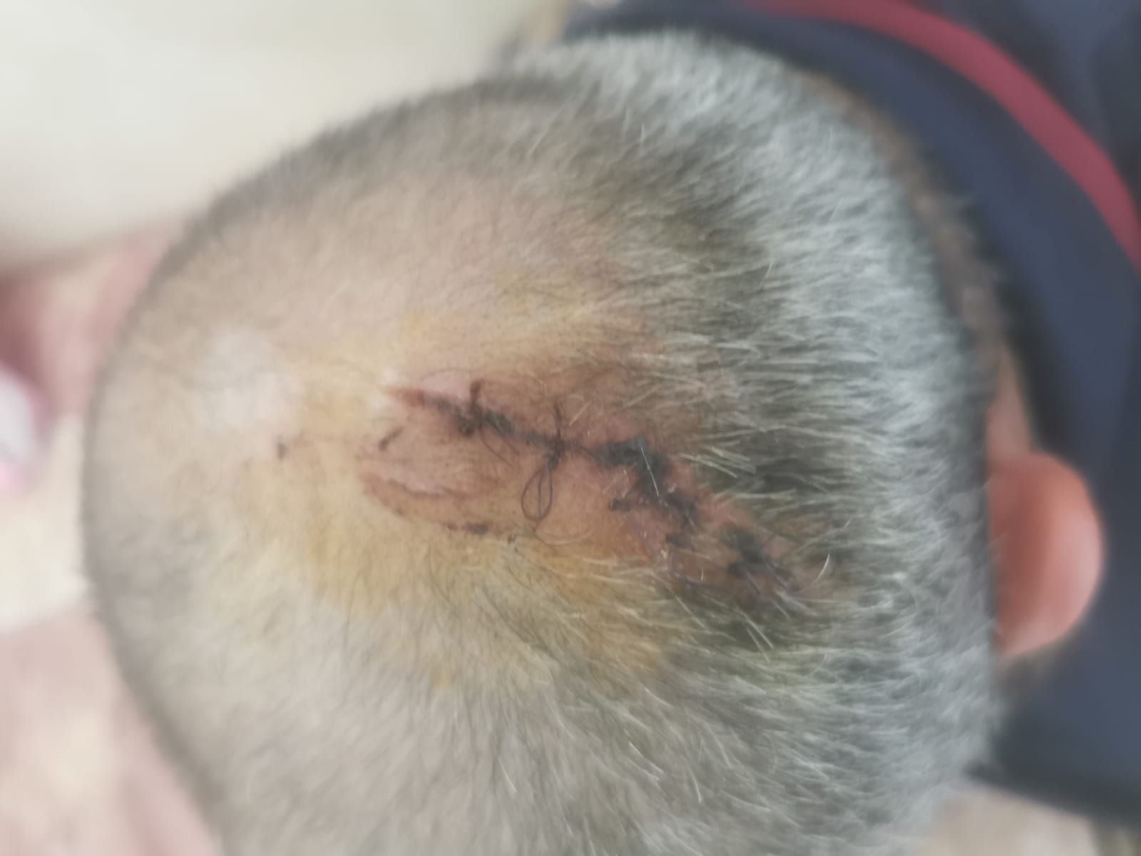 The stitches in Muslem Abu Hameid’s head. Photo courtesy of the witness. 
