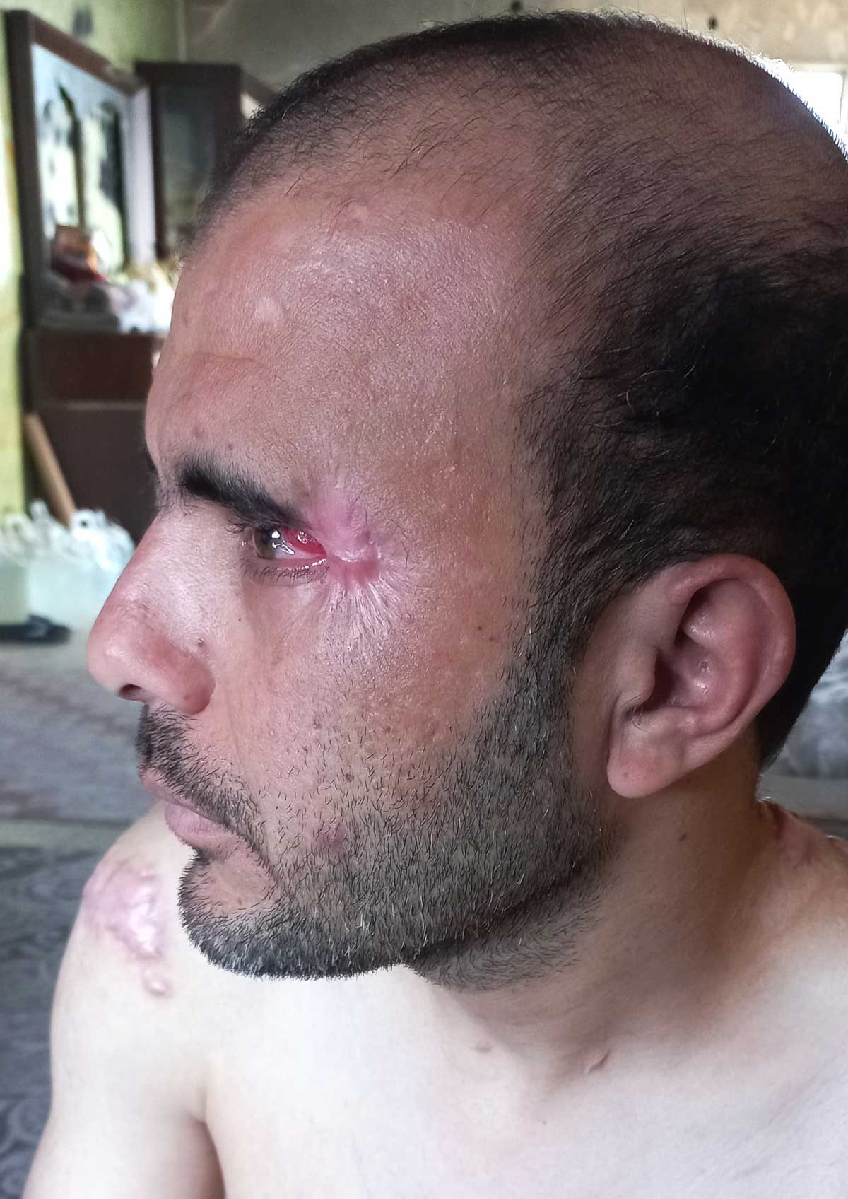 حرق بجانب عين محمد أبو طويلة والإصابة في عينه. صورة قدمها الشاهد مشكورًا