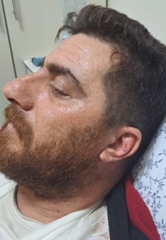 لجرح في أذن فرعونية. تصوير: سلمى الدبعي، بتسيلم