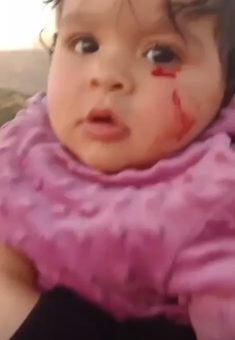 شام حسن بعد إصابتها. صورة قدّمها الشاهد مشكورًا