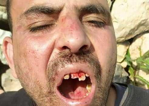 أسنان موسى قطاش الأماميّة المكسورة، 16.4.20. صورة قدمتها العائلة مشكورة