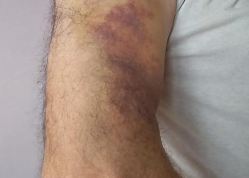 يد عبدالله سلمان المصابة عقب الاعتداء عليه من قبل المسنوطنين في فرعتا، 29.4.20