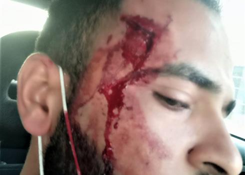 الجُرح في جبين صادق خطاطبة نتيجة حُطام زجاج السيّارة المتناثر جرّاء حجر رشقه مستوطن على السيّارة التي كان يستقلّها. شارع 60، 21.12.20. تصوير صادق خطاطبة.