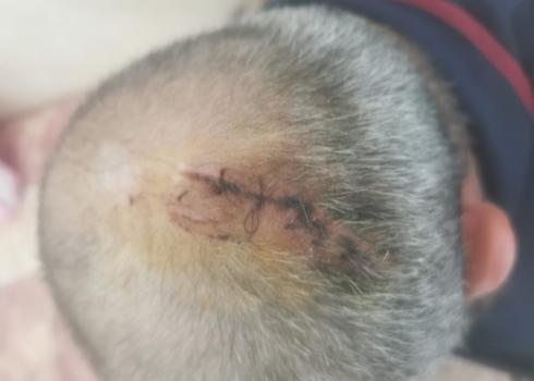 The stitches in Muslem Abu Hameid’s head. Photo courtesy of the witness. 
