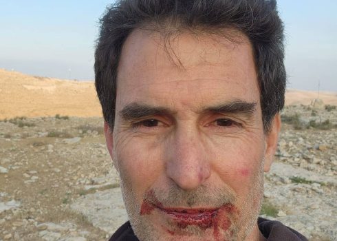 הפעיל הישראלי לאחר שהוכה בידי המתנחל. התמונה באדיבותו